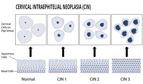 what is coccobacilli in pap smear|Pap Smear Interpretation and Management of Abnormals.